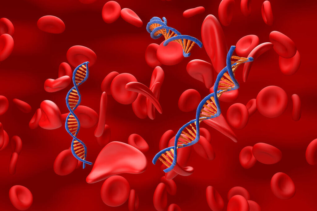 States Expand Gene Therapy for Sickle Cell States Expand Gene Therapy for Sickle Cell